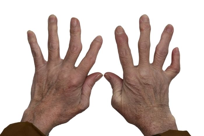 İltihaplı Romatizma Nedir