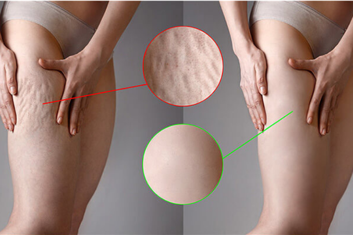 1 Haftada Selülit Nasıl Gider